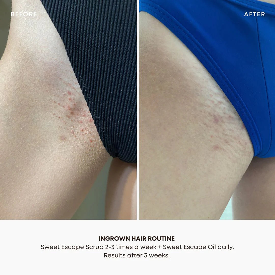 Bushbalm Sweet Escape Ingrown Hair Oil