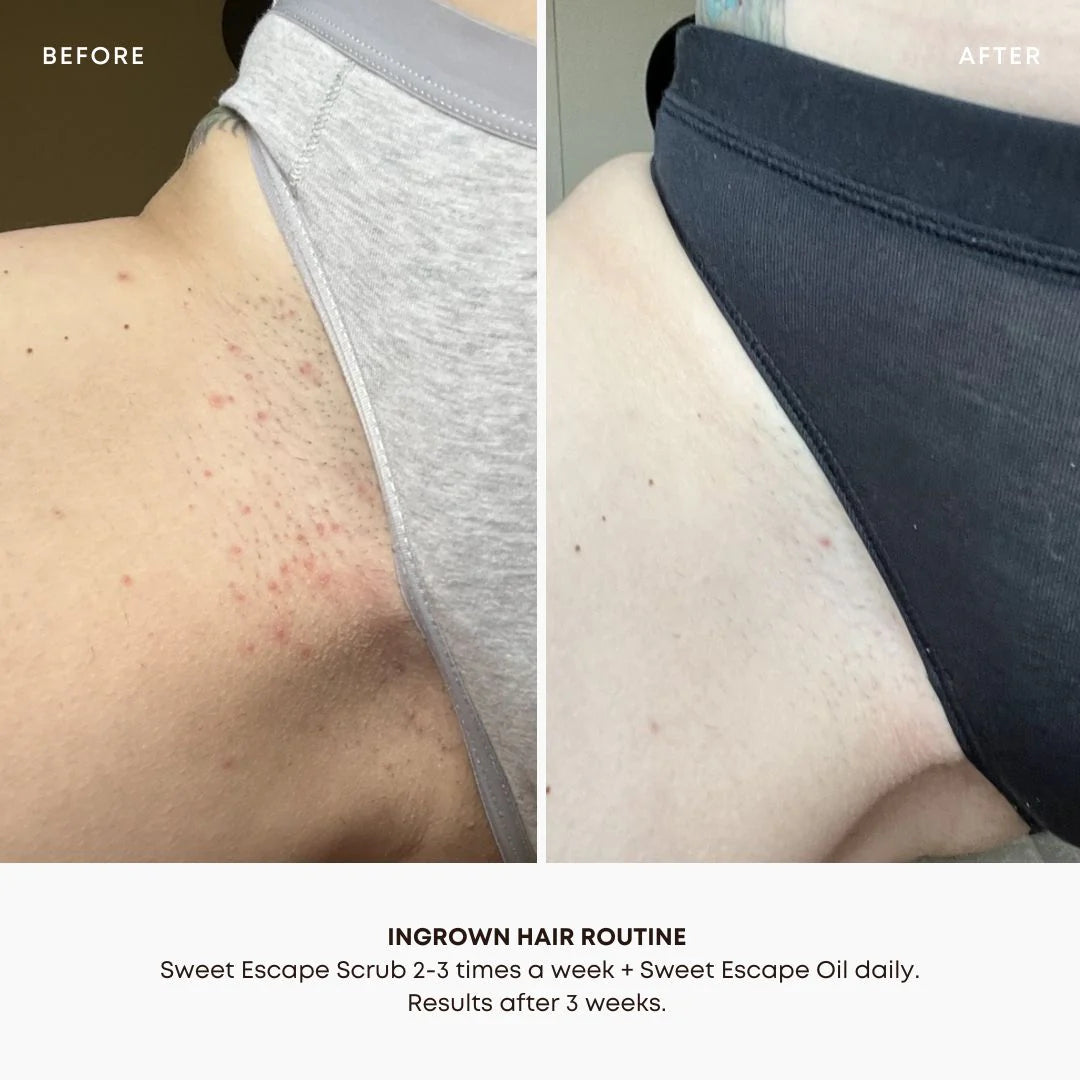 Bushbalm Sweet Escape Ingrown Hair Oil